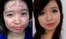 เทคนิคแต่งหน้าขั้นเทพ สำหรับสาวมีสิว