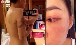 อีกระลอก! ภาพคล้าย เจนี่ โชว์รอยช้ำทั่วร่าง